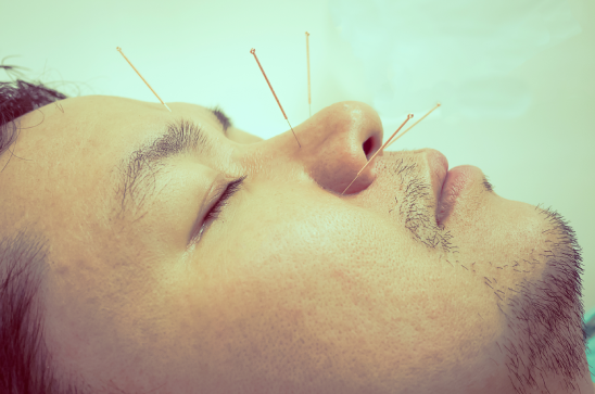 Acupuncture Practices
